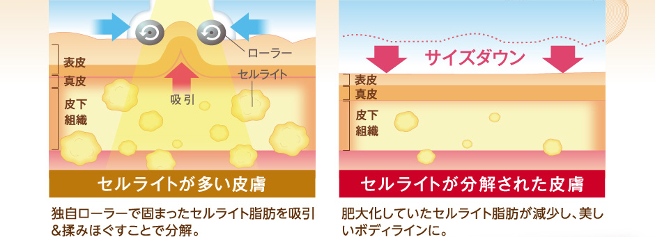 特許取得の独自ローラーでセルライト脂肪を吸引！話題の「エンダモロジー」人気の理由を検証！