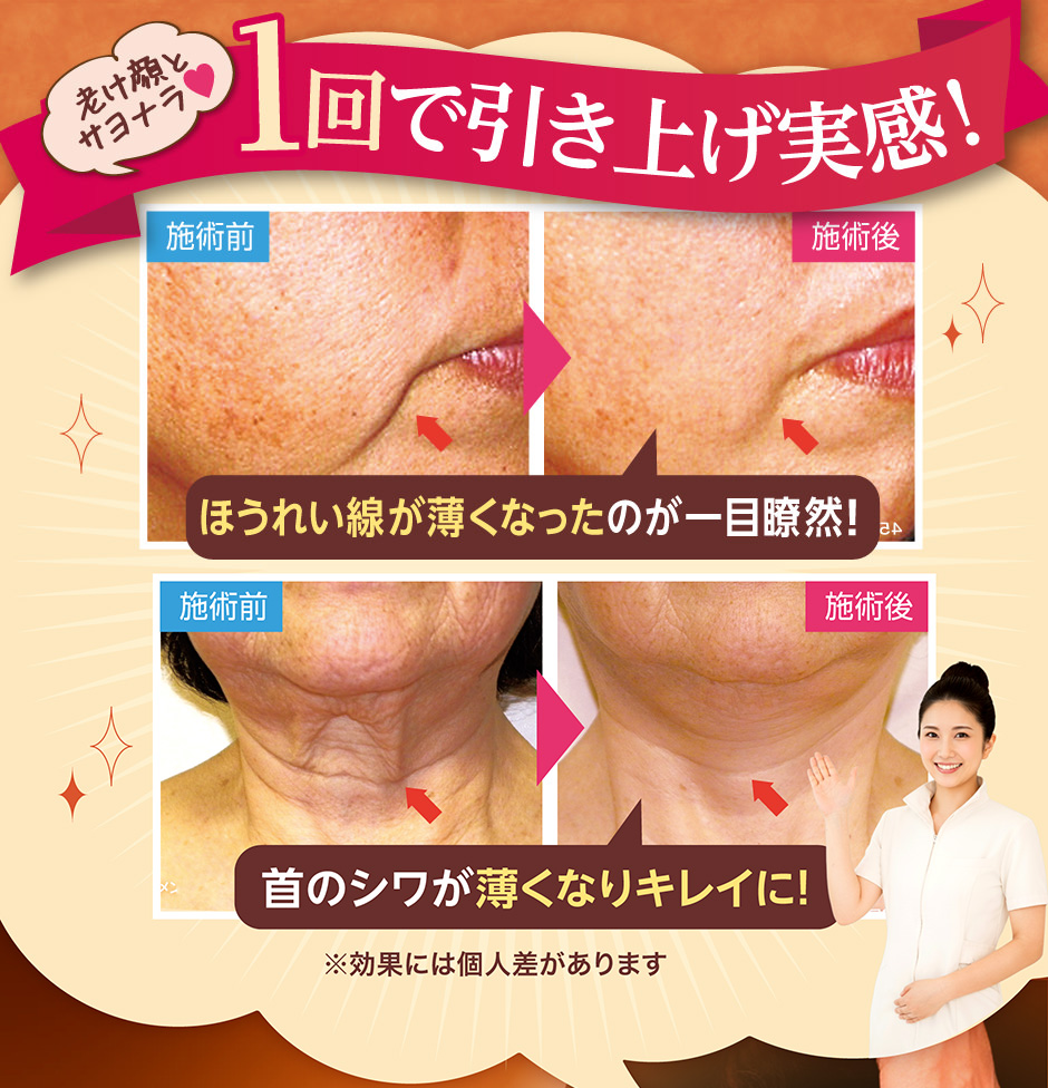 1老け顔とサヨナラ♥回で引き上げ実感！ほうれい線が薄くなったのが一目瞭然！首のシワが薄くなりキレイに！